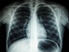 En röntgenbild av en mänsklig torso (Bildkälla: Umanoide via Unsplash; beskuren)
