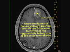 En bild från Michael Prinkes magnetröntgen som laddats upp av hans fru på sociala medier