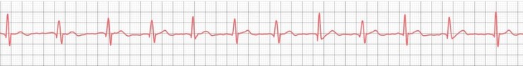 Även prisvärda smartklockor har visat sig kunna registrera enkla EKG-kurvor utan problem