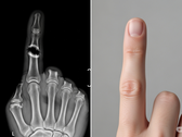 Bone Biologics ansöker om patent för ny teknik för benregenerering (Bildkälla: AI-genererad illustrativ bild)