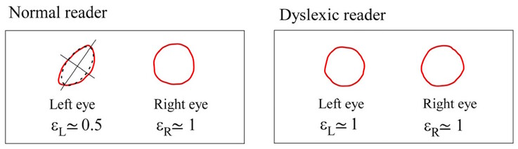 Maxwells centroider skiljer sig åt i symmetri hos normala försökspersoner, men är likartade hos dyslektiska försökspersoner. (Bildkälla: DOI 10.3390/brainsci13101478) 