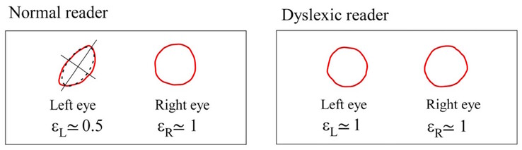 Maxwells centroider skiljer sig åt i symmetri hos normala försökspersoner, men är likartade hos dyslektiska försökspersoner. (Bildkälla: DOI 10.3390/brainsci13101478)